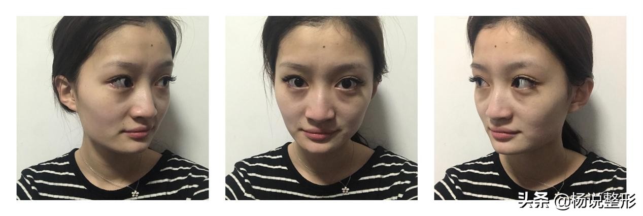 割完眼袋眼肿为什么,割完眼袋显得眼凶