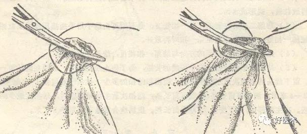 结扎止血时用哪种缝合方法,外科血管止血结扎的基本操作
