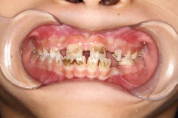 8岁的孩子能做牙齿矫正吗,7岁孩子矫正牙齿早吗