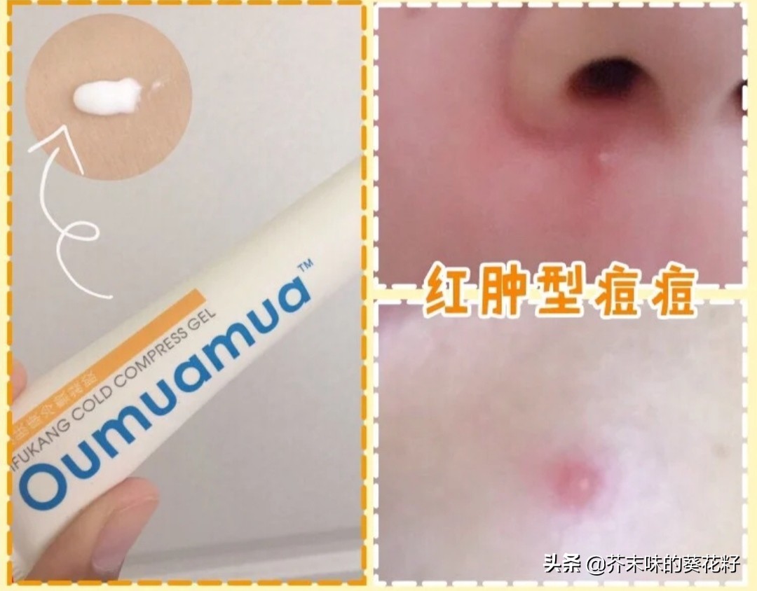 不同部位痘痘消除方法小学生,不同类型的痘痘的祛痘方法