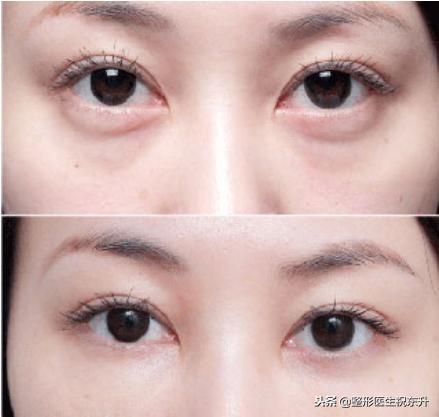 抽脂去眼袋和切口去眼袋效果对比,抽脂去眼袋后悔了