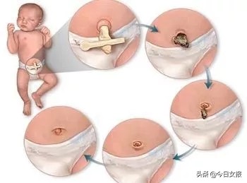新生儿脐带切断后如何护理,脐带剪断后孩子的肚脐怎么办