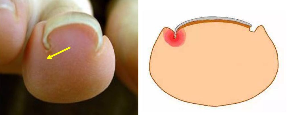 脚趾甲往肉里长不疼是甲沟炎吗,脚趾甲长到肉里引发甲沟炎怎么办