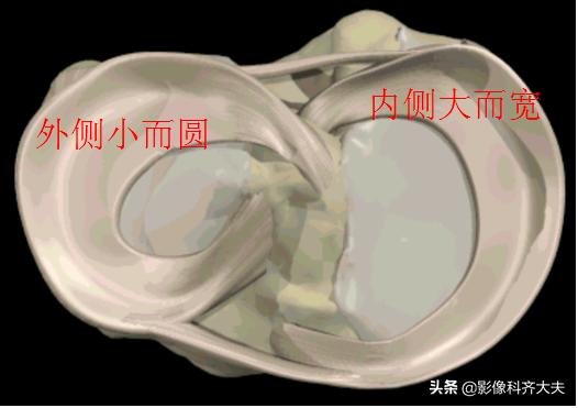 膝关节半月板损伤的磁共振,膝关节半月板病变的mri诊断与鉴别