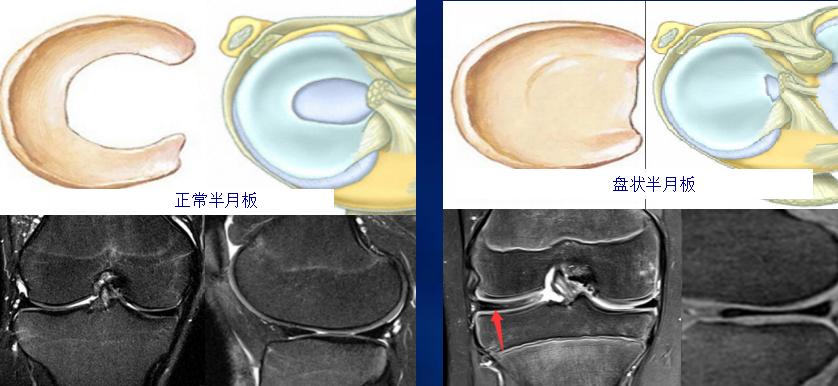 半月板损伤康复训练,半月板损伤膝盖疼的最好治疗方法