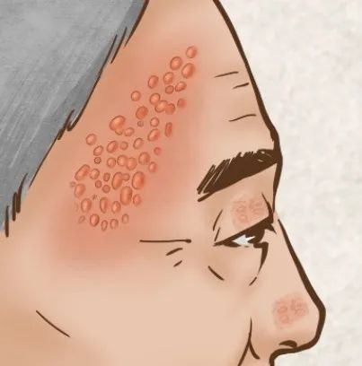 同事长了好多疮会传染吗,同事皮肤病会传染吗