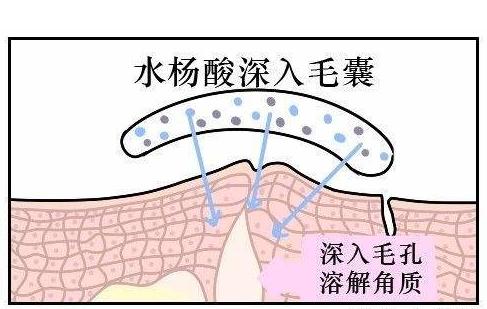 皮肤毛孔变大有脏东西怎么办,脸上毛孔粗大出油能挤出白色颗粒