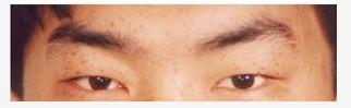 内眼角和外眼角哪个好恢复,内眼角和外眼角哪个回缩厉害