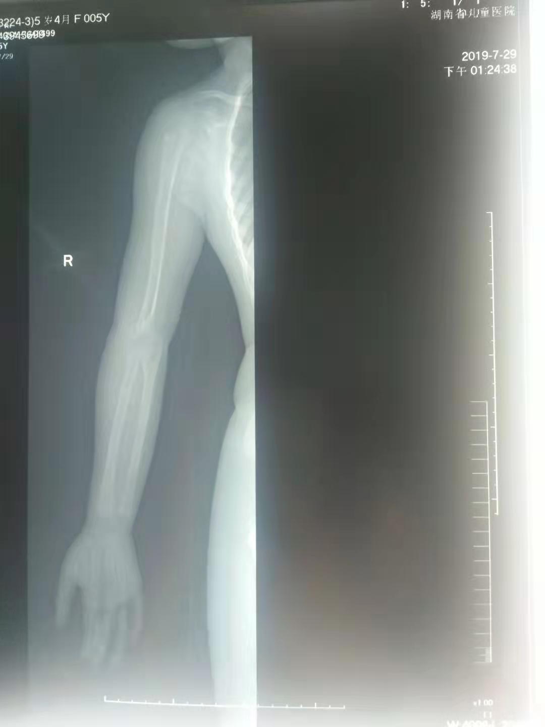 骨折复位错位1.4毫米有影响么,骨折错位一个月还能手法复位吗