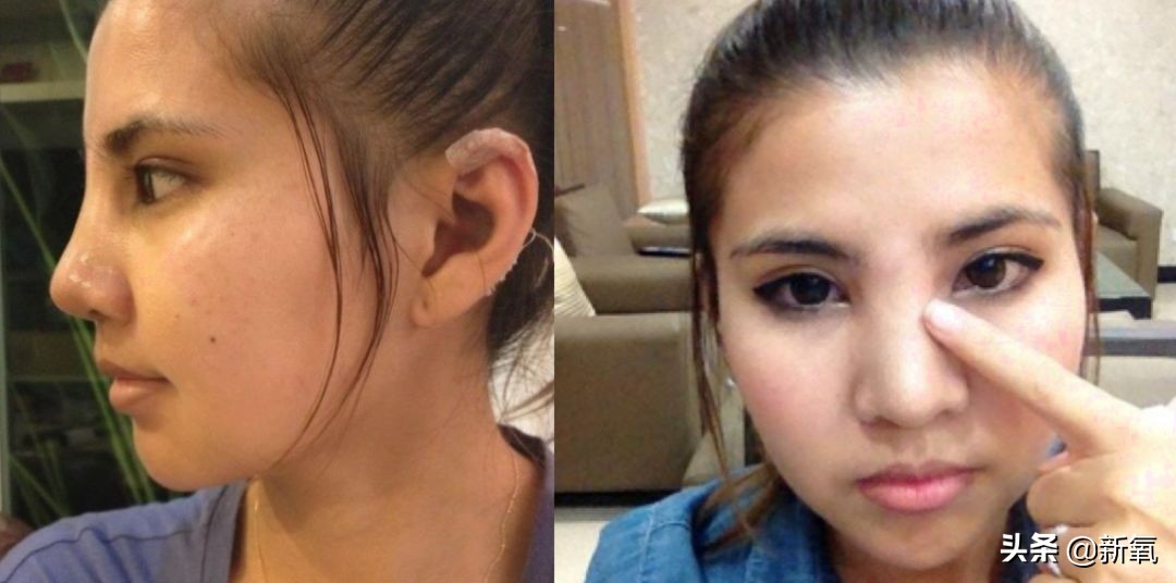 18岁土肥圆豪掷800万全身整形，鼻子6次大整假体穿出，效果却超美