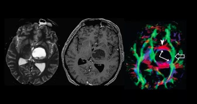 磁共振成像mri的基本原理,磁共振后dti怎么处理