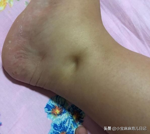 脚肿水肿怎么消肿最快最好的方法,怀孕腿脚水肿是怎么回事