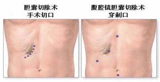 腹腔镜微创手术是做什么的,腹腔镜微创手术治疗啥的