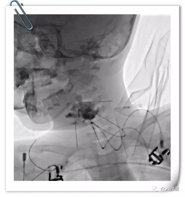 淋巴管畸形硬化治疗费用,静脉畸形硬化的最佳治疗方法