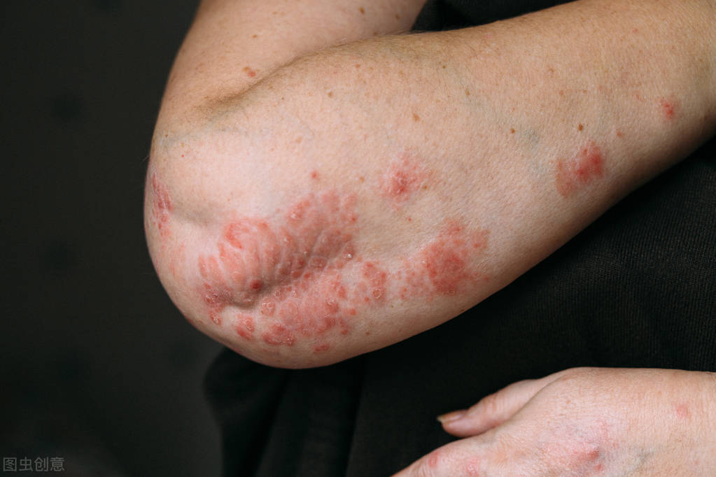 过敏性皮炎用什么药膏止痒快,皮炎瘙痒越挠越痒是什么原因