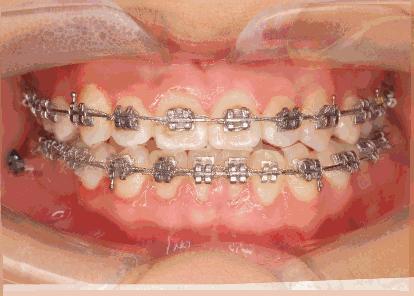 新款牙齿矫正价格,牙齿矫正性价比高品牌