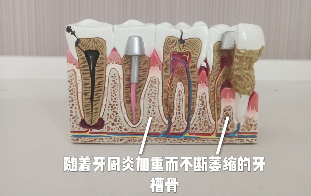 Helen齿科中心——牙周炎的危害