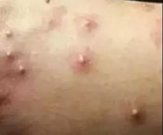 广西一女子被蚂蚁咬伤后不幸身亡,广西姑娘被一只蚂蚁咬到紧急住院