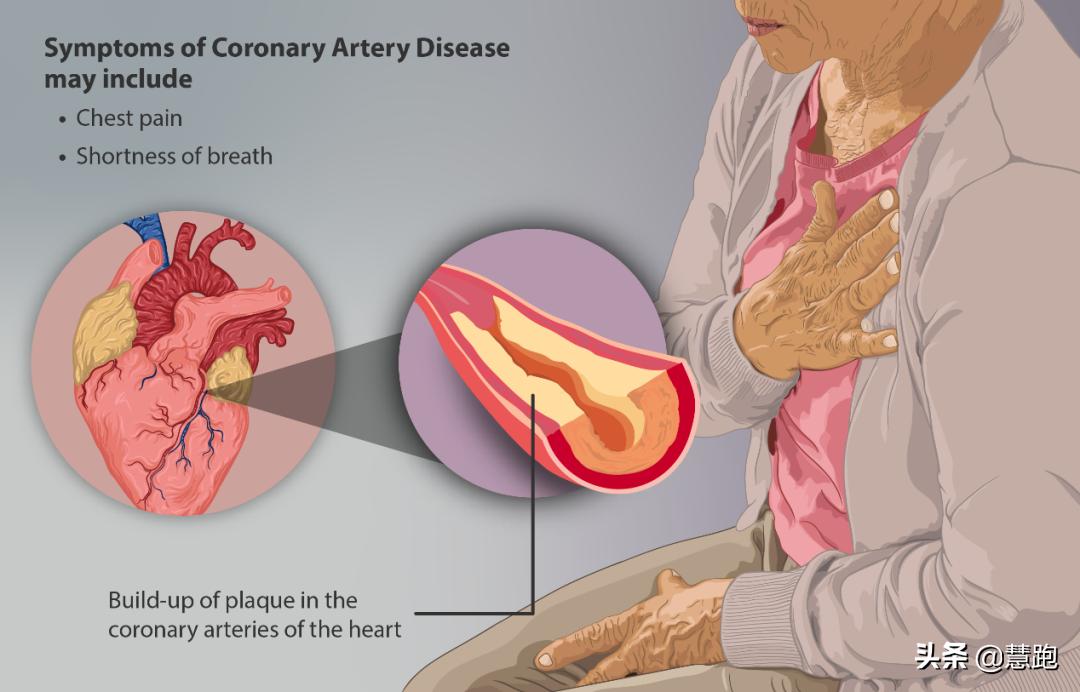 一男子突发心跳骤停获救,2018跑步心脏骤停两次继续跑