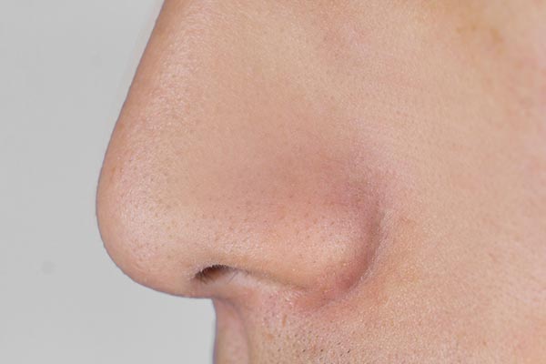 鼻子上挤出白色长条怎么解决,鼻子两侧每天都能挤出白色的东西