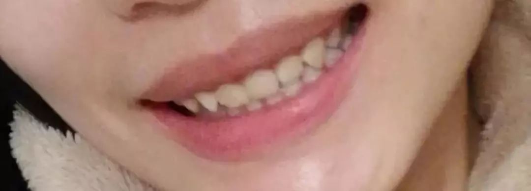 深覆盖vs深覆合,深覆盖和深覆合哪个难度大