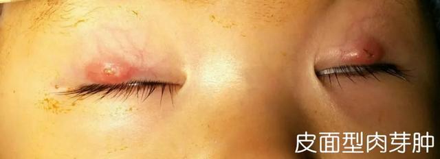 眼睛感染过后麦粒肿还是霰粒肿,眼皮红肿麦粒肿霰粒肿形成机理