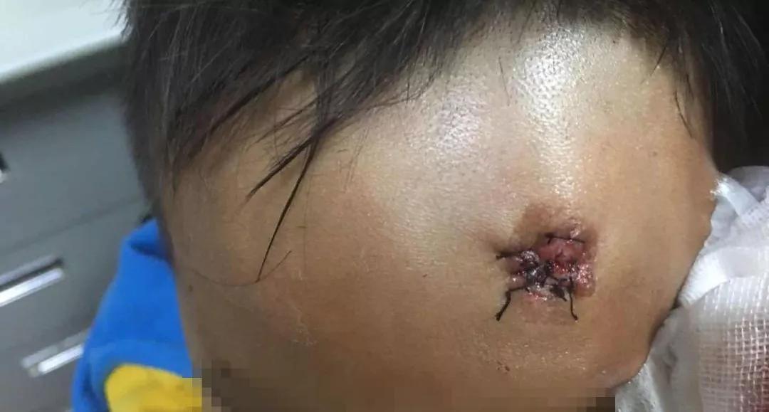 男孩摔到后脑勺做开颅手术,娃儿头骨摔断做开颅手术