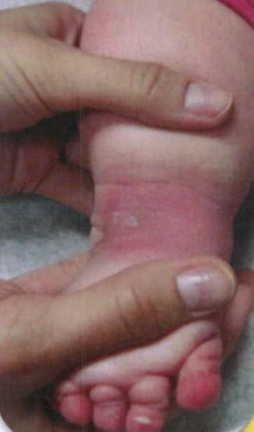 马蹄内翻足支具需要穿多久,马蹄内翻足穿鞋了怎么按摩