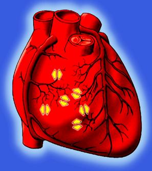 冠状动脉狭窄50%吃药能治好吗,冠状动脉狭窄50%以下心绞痛怎么办