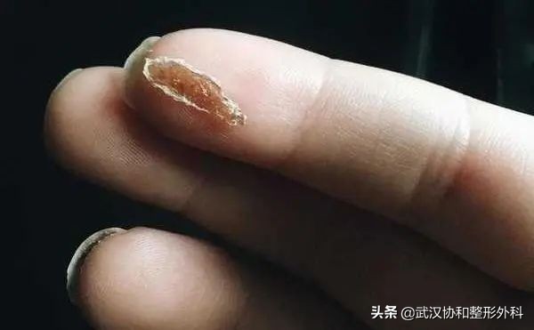 手术后怎么预防疤痕用什么药膏,预防疤痕增生最佳方法