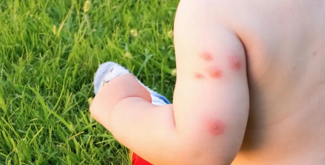 皮肤过敏发痒可以用炉甘石洗剂,儿童皮肤问题擦什么面霜