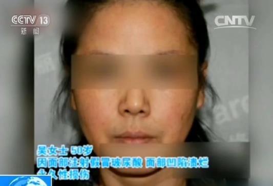 经常打玻尿酸10年后会有什么变化,连打几次玻尿酸就会持久呢