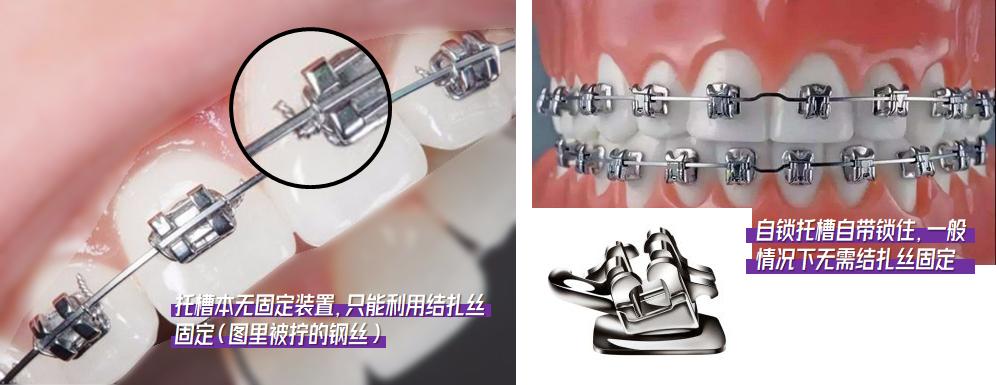 24岁戴牙套还能改善嘴凸吗,24岁戴牙套要戴多久保持器