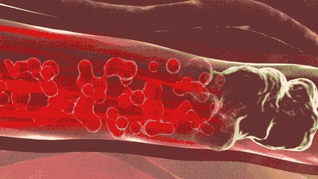 不想支架有必要做造影吗,不想脑出血脑梗心梗要注意什么