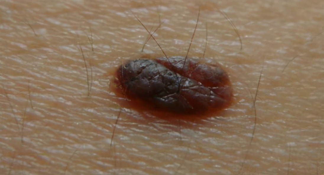 身上长了小黑点是不是癌症,头上有个黑痣是黑色素瘤吗