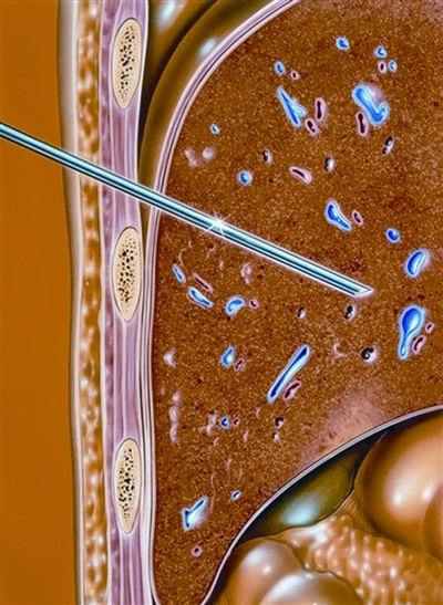 乙肝病人转氨酶高对肝有什么影响,慢性乙肝引起转氨酶高200