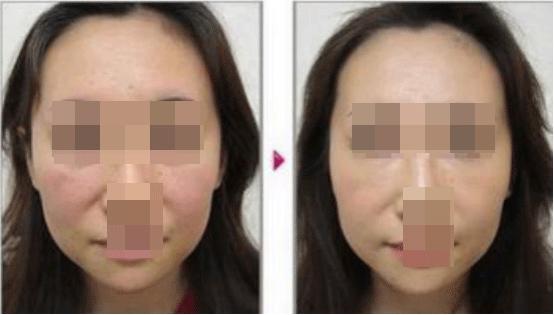 脸松弛下垂法令纹做什么医美手术,法令纹苹果肌下垂做什么手术