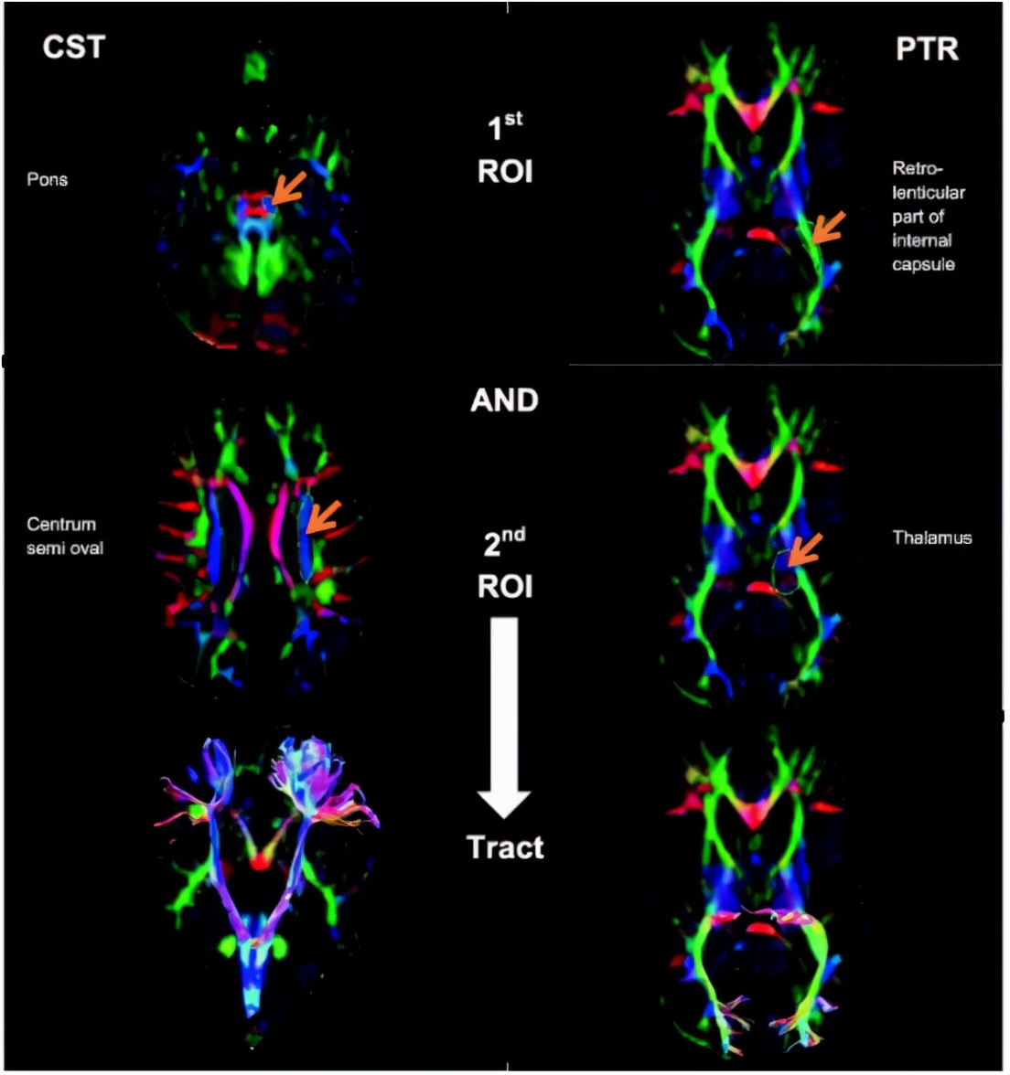 临床研究证实:围产组织间充质干细胞能改善脑瘫儿童的症状
