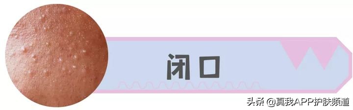 脸上长痘痘反反复复该怎么办,脸上一个部位反反复复长痘痘