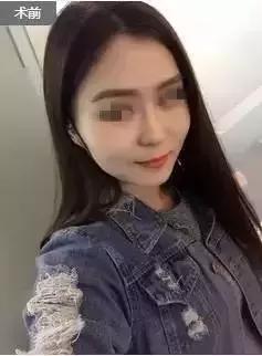 瘦脸针的5个常见问题,瘦脸针其实副作用挺大的