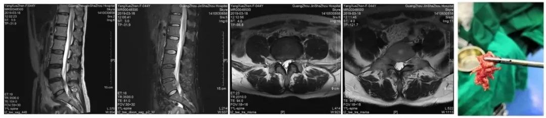 中西医结合治疗脊椎病，个性化定制治疗方案