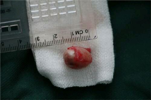 预防粉瘤,脂肪瘤怎样预防及治疗