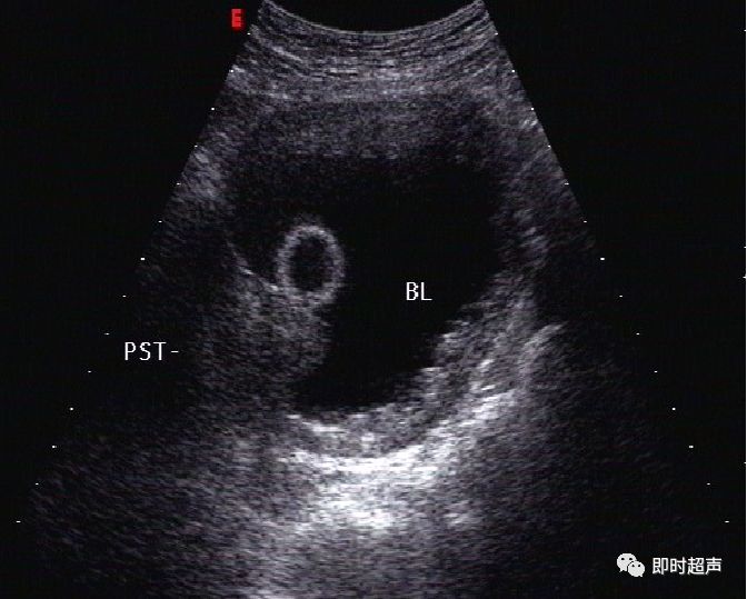 膀胱超声图解大全,膀胱超声解剖及常见病变超声表现