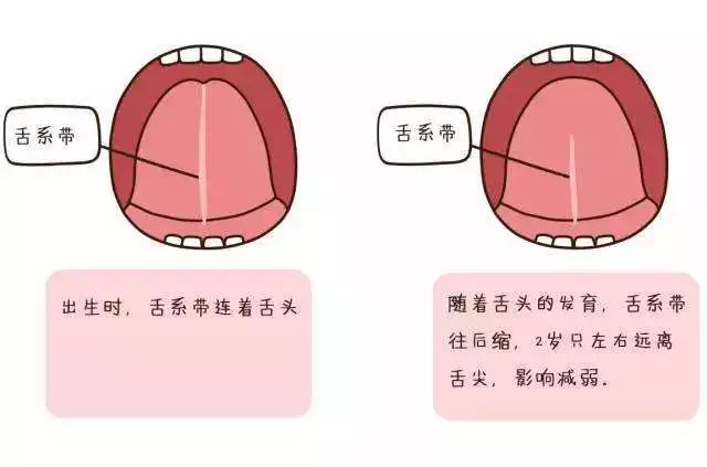 小孩说话口齿不清是什么病的前兆,小孩说话口齿不清是什么原因呢