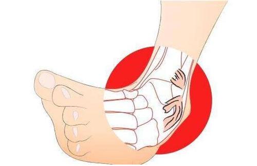 脚踝骨折90天走路骨折处有点疼,脚踝骨折一个月以后如何做康复