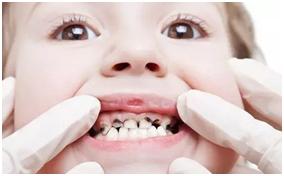 牙疼是因为蛀牙么,你有蛀牙和牙疼的困扰吗