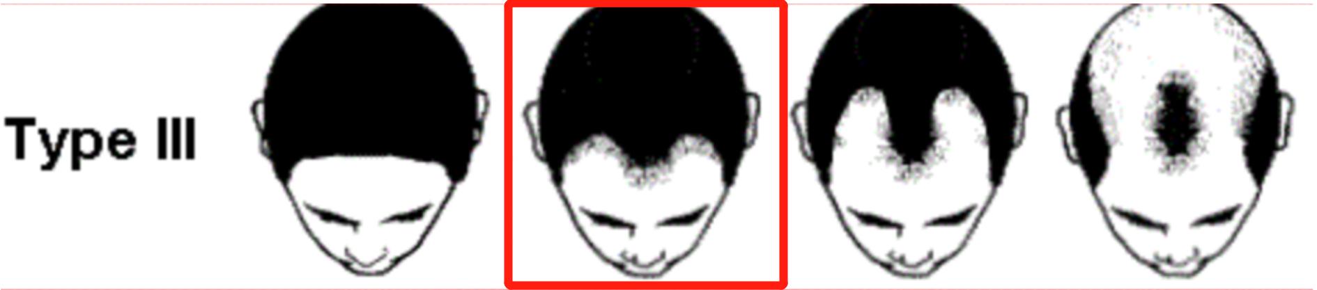 裘德洛的秃头适合什么发型,裘德洛秃顶