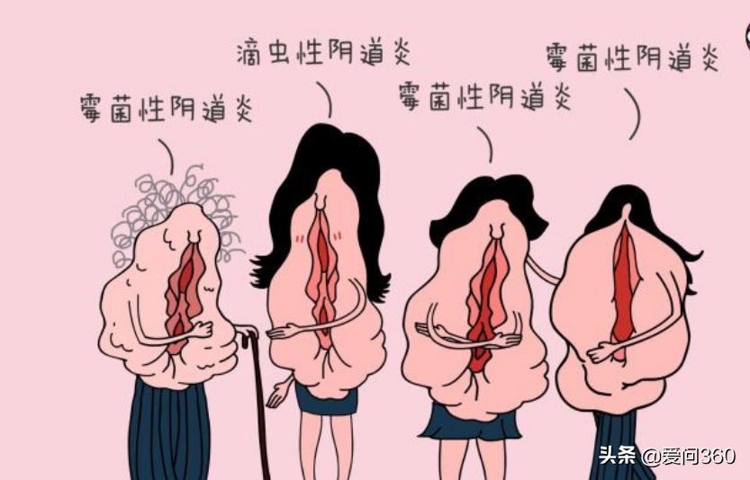 得了阴道炎怎么避免反复,阴道炎反复发作要怎么彻底治疗