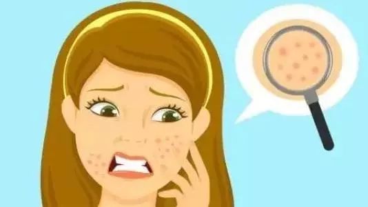 鼻子上都是黑头还有点肿,鼻子上很多颗粒黑头