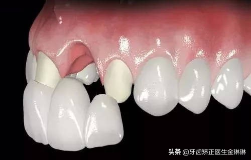 做的烤瓷牙根部发黑了怎么回事,做的烤瓷牙很久了牙根疼怎么回事